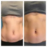 Before and After Microcurrent Body Treatment