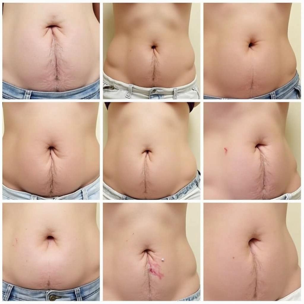 Belly Button Incision Healing Process