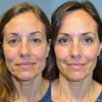 Correcting Chin Filler Asymmetry