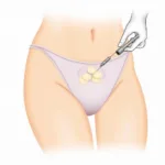 Fat Transfer to Labia Majora Procedure Illustration