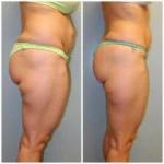 Before and After Photos of Laser Liposuction on Thighs