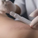 Close-up of a milia extraction procedure