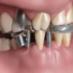 Permanent Retainer Detached After 15 Years