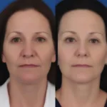 Plasma Pen Treatment Before and After Comparison Image Showing Skin Tightening Results