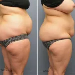 Plus Size Lipo 360 Before & After Results