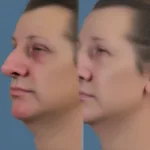 Septorhinoplasty Initial Recovery - Image showing the immediate post-operative phase with swelling and bruising.