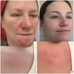 Tallow Eczema Before and After Improvement