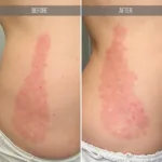 Before and After Microneedling Stretch Marks