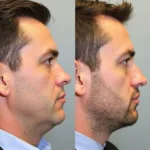 Chin Filler Before and After Men Comparison