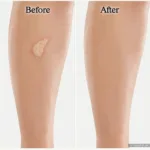 Before and After Concealer Application for Spider Veins on Legs