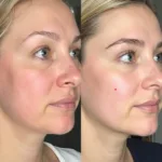 Cryofacial Before and After Comparison Images