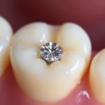 Close-up of a crystal tooth gem on an incisor