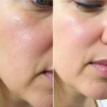 Dermaplaning Before and After Wrinkles Comparison Image