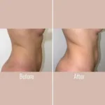 Designer Nipple Before and After: Inverted Nipple Correction