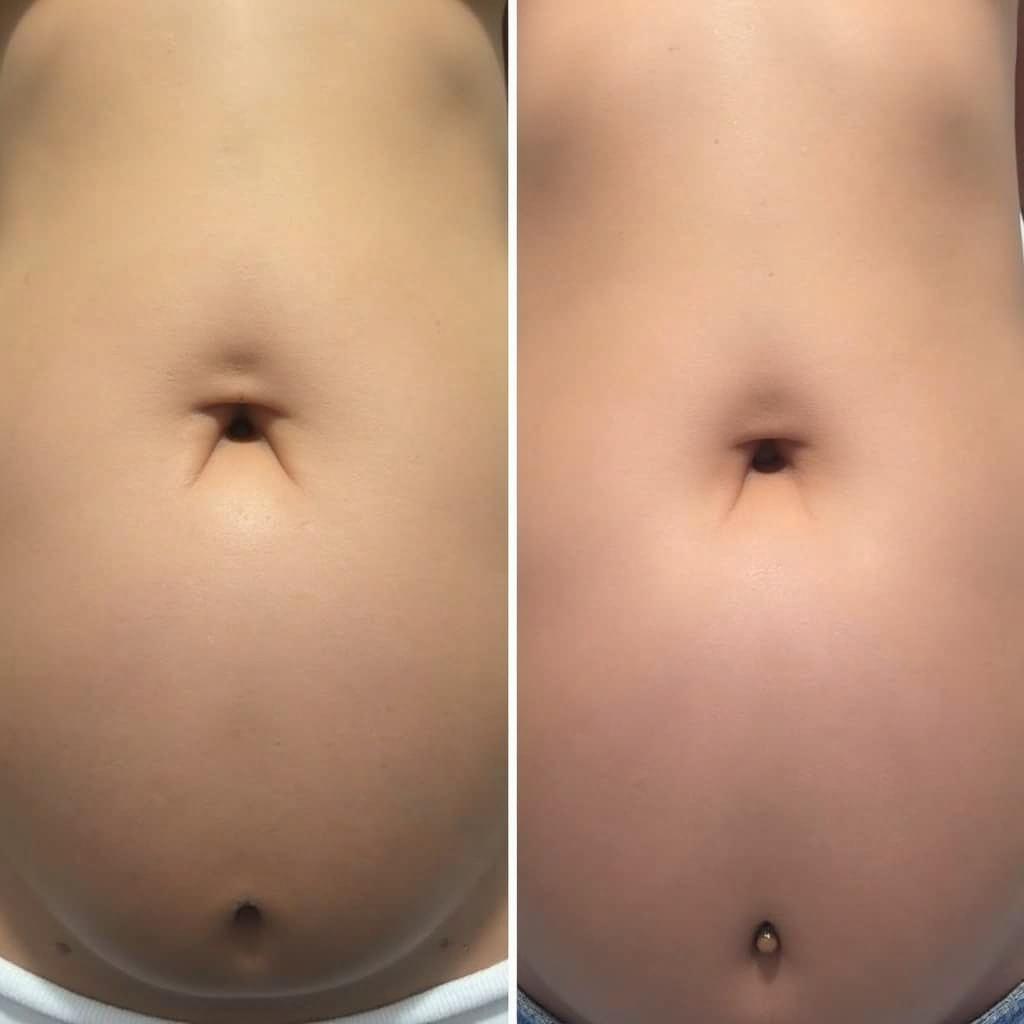 Hooded Belly Button Umbilicoplasty