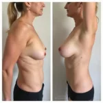 Internal Mesh Sling Breast Lift Results