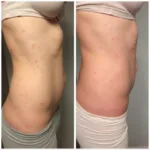 Before and after images of using It Works stretch mark cream