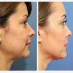 Kybella Before and After Results