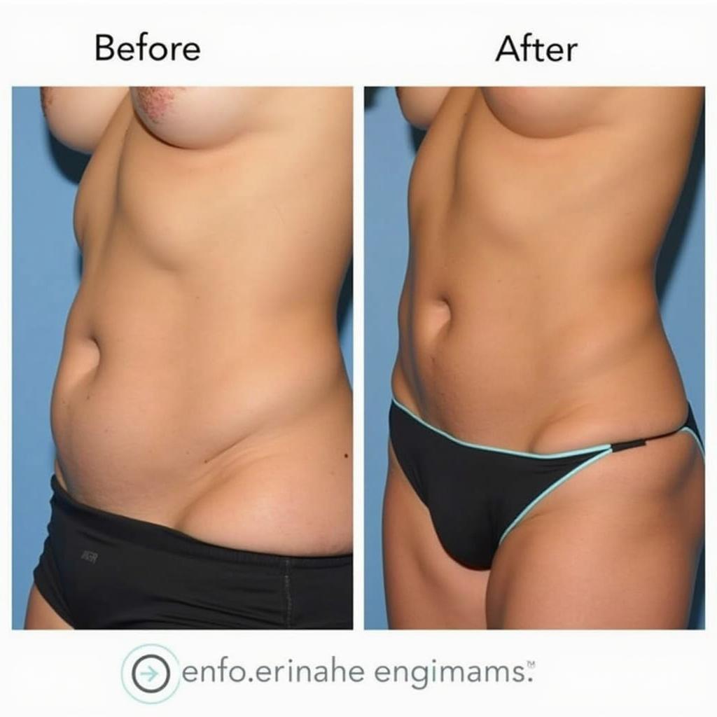 Laser Lipo Before and After Abdomen Transformation