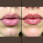 Before and After Lip Collagen Treatment