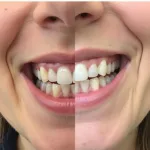 Long-Term Results of Lip Shortening