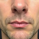 Male Lip Lift Results