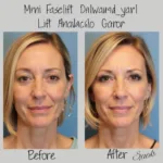 Mini Facelift Results in 40s