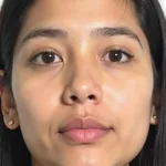 Natural-Looking Filipino Rhinoplasty Results