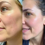 Skin Texture Before and After CO2 Laser