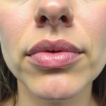 Example of Overfilled Lips