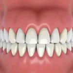 Retainer and Gum Recession