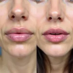 Rha Lip Filler Before and After Comparison Images