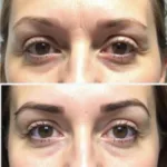 Under Eye Filler Before and After Comparison