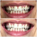 Veneers for Teeth Straightening and Whitening