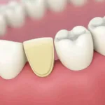 Plaque Buildup Between Teeth