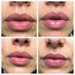 Xeomin Lip Flip Before and After Photos